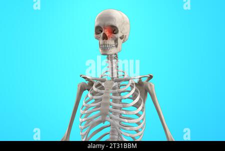 3D medical Illustration of Cranial Nose Fracture on Human Skeleton Stock Photo
