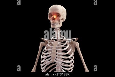 3D medical Illustration of Cranial Nose Fracture on Human Skeleton Stock Photo