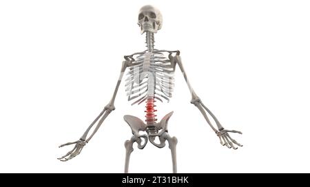 Lower back pain. Human Lumbar Spine x-Ray Front View Female 75 year old ...