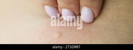 Female hand touches skin with rash examining eczema Stock Photo
