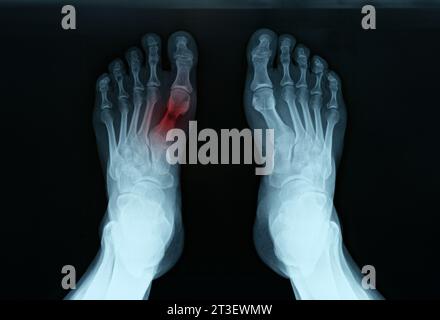 X ray of feet with tarsal fracture closeup Stock Photo