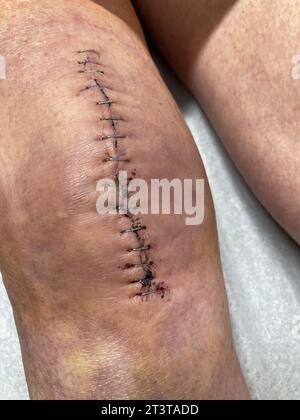 Close-up view of woman with large scar on knee after surgery Stock Photo