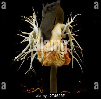CTA pulmonary artery  or CTPA with contrast media 3D rendering  normal pulmonary artery. Stock Photo