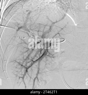 Portal Vein Embolization (PVE) is a medical procedure used to remaining ...