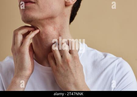 Close up of young man scratching neck suffering from itch and allergies, copy space Stock Photo