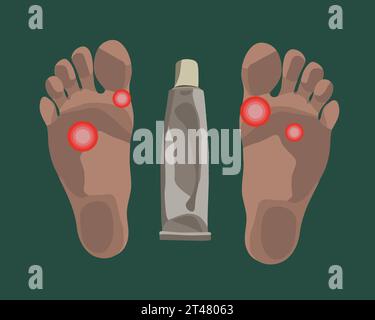 Vector isolated illustration of foot fungus. Fungal ointment. Stock Vector