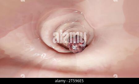 Colorectal cancer, malignant tumor in intestine, Endoscope inside colonoscopy, gut intestine, Colon polyp removal, colonic polyps search, Polypectomy, Stock Photo