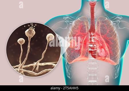 Lung mucormycosis lesion, illustration Stock Photo