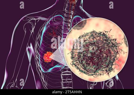 Lung cancer tumour and malignant cells, illustration Stock Photo