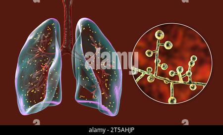 Lung adiaspiromycosis, illustration Stock Photo - Alamy