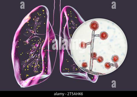 Lung adiaspiromycosis, illustration Stock Photo - Alamy