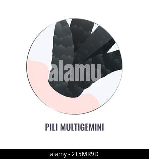Pili multigemini hair disorder in close up Stock Vector Image & Art - Alamy