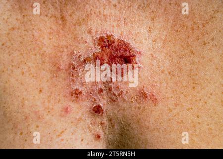 Superficial basal cell carcinoma reacting to imiquimod cream medication after consistent treatment showing red lesion on 30s caucasian female chest. Stock Photo