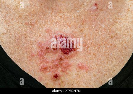 Superficial basal cell carcinoma reacting to imiquimod cream medication after consistent treatment showing red lesion on 30s caucasian female chest. Stock Photo