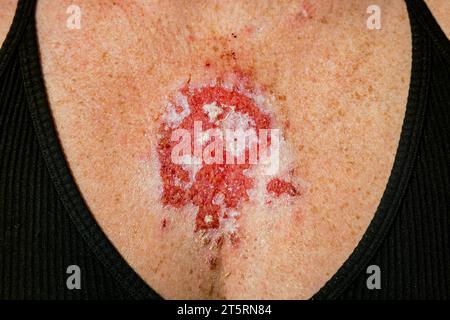 Superficial basal cell carcinoma reacting to imiquimod cream medication after consistent treatment showing red lesion on 30s caucasian female chest. Stock Photo