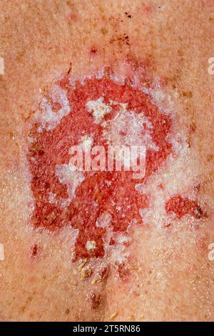 Superficial basal cell carcinoma reacting to imiquimod cream medication after consistent treatment showing red lesion on 30s caucasian female chest. Stock Photo