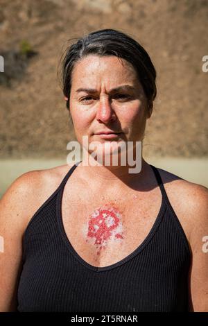 30s caucasian female displaying superficial basal cell carcinoma reacting to imiquimod cream therapy after consistent use showing red lesion on chest. Stock Photo