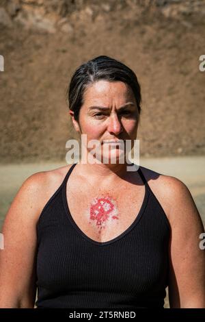 30s caucasian female displaying superficial basal cell carcinoma reacting to imiquimod cream therapy after consistent use showing red lesion on chest. Stock Photo