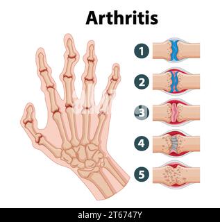 Hand Arthritis Algorithm Illustrated infographic depicting stages of arthritis in human hand ...