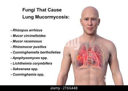 A 3D photorealistic illustration of the upper half part of a man with transparent skin, revealing a lung mucormycosis lesion. Stock Photo