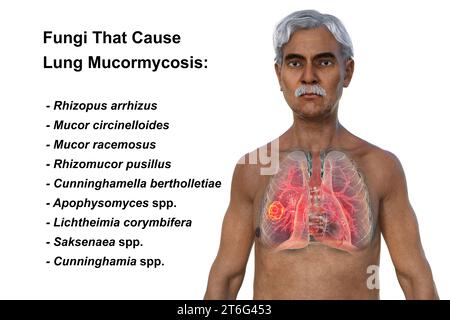 A 3D photorealistic illustration of the upper half part of a senior man with transparent skin, revealing a lung mucormycosis lesion. Stock Photo