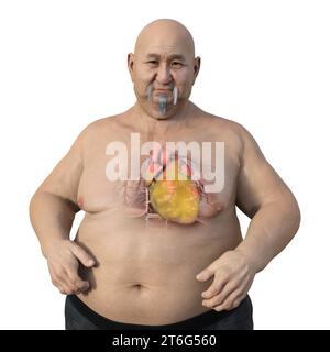 A 3D medical illustration of an overweight man with transparent skin, showcasing an enlarged and obese heart. Stock Photo