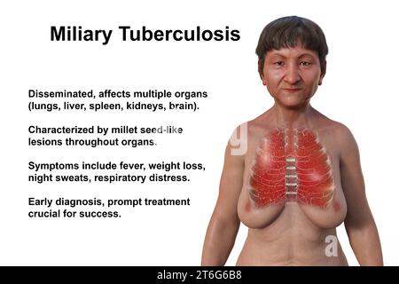 A 3D photorealistic illustration of the upper half of a woman with transparent skin, showcasing the lungs affected by miliary tuberculosis. Stock Photo