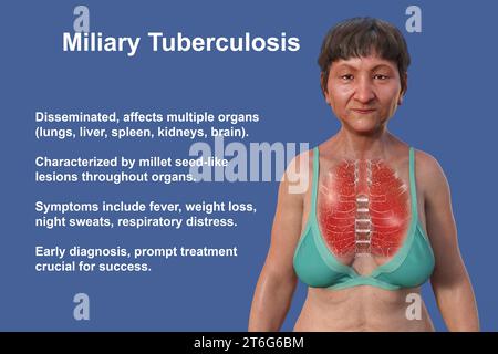 A 3D photorealistic illustration of the upper half of a woman with transparent skin, showcasing the lungs affected by miliary tuberculosis. Stock Photo