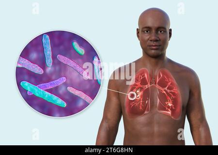 A 3D photorealistic illustration of the upper half of a man with transparent skin, showcasing the lungs affected by cavernous tuberculosis, and close- Stock Photo