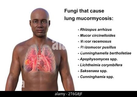 A 3D photorealistic illustration of the upper half part of an African man with transparent skin, revealing a lung mucormycosis lesion Stock Photo