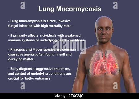 A 3D photorealistic illustration of the upper half part of an African man with transparent skin, revealing a lung mucormycosis lesion Stock Photo