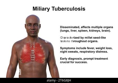 A 3D photorealistic illustration of the upper half of a man with transparent skin, showcasing the lungs affected by miliary tuberculosis Stock Photo
