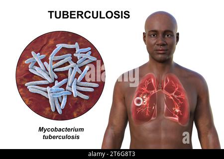 A 3D photorealistic illustration of the upper half of a man with transparent skin, showcasing the lungs affected by cavernous tuberculosis, and close- Stock Photo