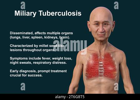 A 3D photorealistic illustration of the upper half of a man with transparent skin, showcasing the lungs affected by miliary tuberculosis Stock Photo