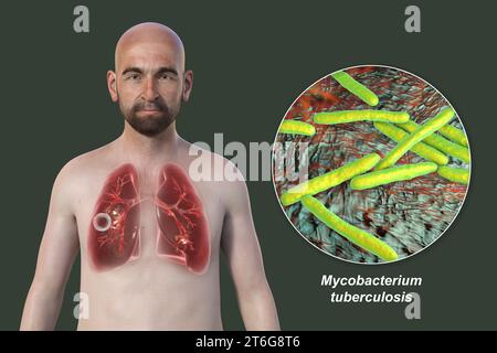 A 3D photorealistic illustration of the upper half of a man with transparent skin, showcasing the lungs affected by cavernous tuberculosis and close-u Stock Photo