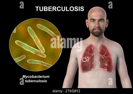 A 3D photorealistic illustration of the upper half of a man with transparent skin, showcasing the lungs affected by cavernous tuberculosis and close-u Stock Photo