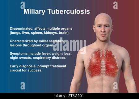 A 3D photorealistic illustration showcasing the upper half part of a man with transparent skin, revealing the lungs affected by miliary tuberculosis Stock Photo