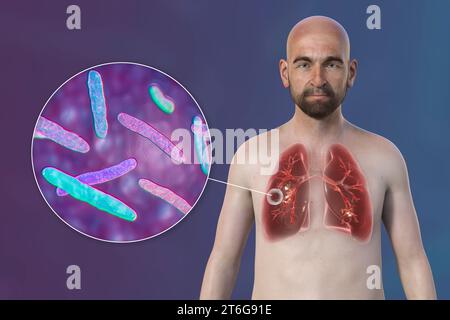 A 3D photorealistic illustration of the upper half of a man with transparent skin, showcasing the lungs affected by cavernous tuberculosis and close-u Stock Photo