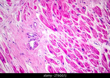 Photomicrograph of myocardial infarction, showing damaged heart tissue due to reduced blood supply and cell death. Stock Photo