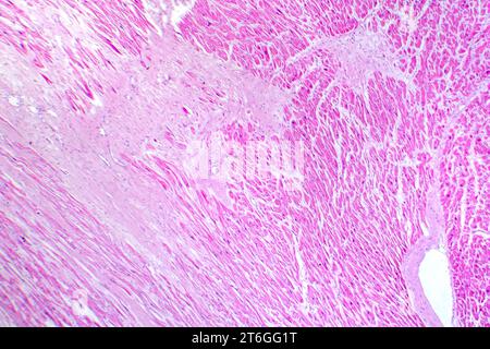 Photomicrograph of myocardial infarction, showing damaged heart tissue due to reduced blood supply and cell death. Stock Photo