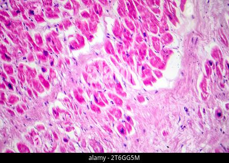 Photomicrograph of myocardial infarction, showing damaged heart tissue due to reduced blood supply and cell death. Stock Photo