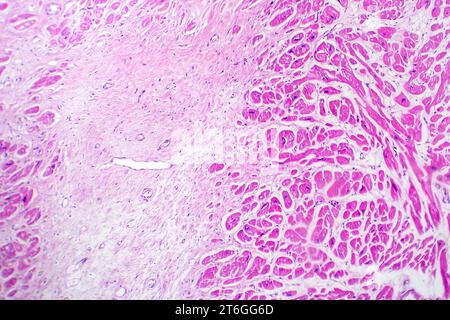 Photomicrograph of myocardial infarction, showing damaged heart tissue due to reduced blood supply and cell death. Stock Photo