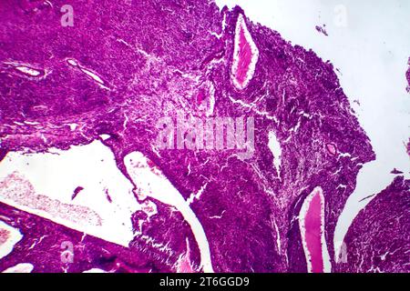 Photomicrograph of fibrosarcoma, revealing malignant fibroblasts and collagen-rich connective tissue, characteristic of aggressive soft tissue cancer. Stock Photo