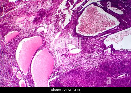 Photomicrograph of fibrosarcoma, revealing malignant fibroblasts and collagen-rich connective tissue, characteristic of aggressive soft tissue cancer. Stock Photo