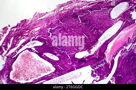 Photomicrograph of fibrosarcoma, revealing malignant fibroblasts and collagen-rich connective tissue, characteristic of aggressive soft tissue cancer. Stock Photo