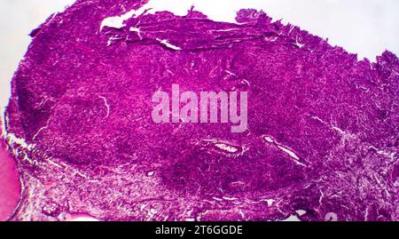 Photomicrograph of fibrosarcoma, revealing malignant fibroblasts and collagen-rich connective tissue, characteristic of aggressive soft tissue cancer. Stock Photo