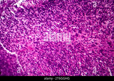 Photomicrograph of fibrosarcoma, revealing malignant fibroblasts and collagen-rich connective tissue, characteristic of aggressive soft tissue cancer. Stock Photo