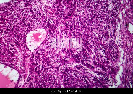 Photomicrograph of fibrosarcoma, revealing malignant fibroblasts and collagen-rich connective tissue, characteristic of aggressive soft tissue cancer. Stock Photo