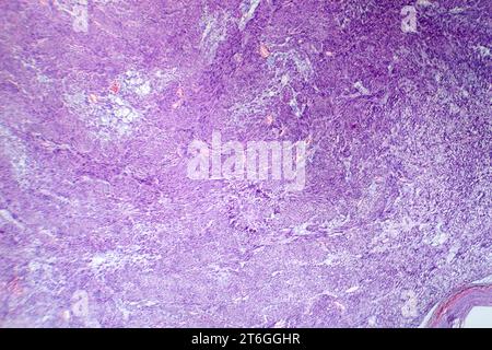 Photomicrograph of leiomyoma, illustrating benign smooth muscle tumor cells within the uterine tissue. Stock Photo