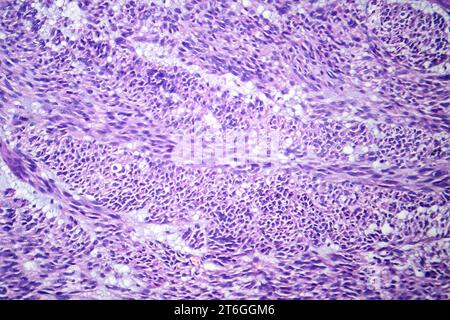 Photomicrograph of leiomyoma, illustrating benign smooth muscle tumor cells within the uterine tissue. Stock Photo